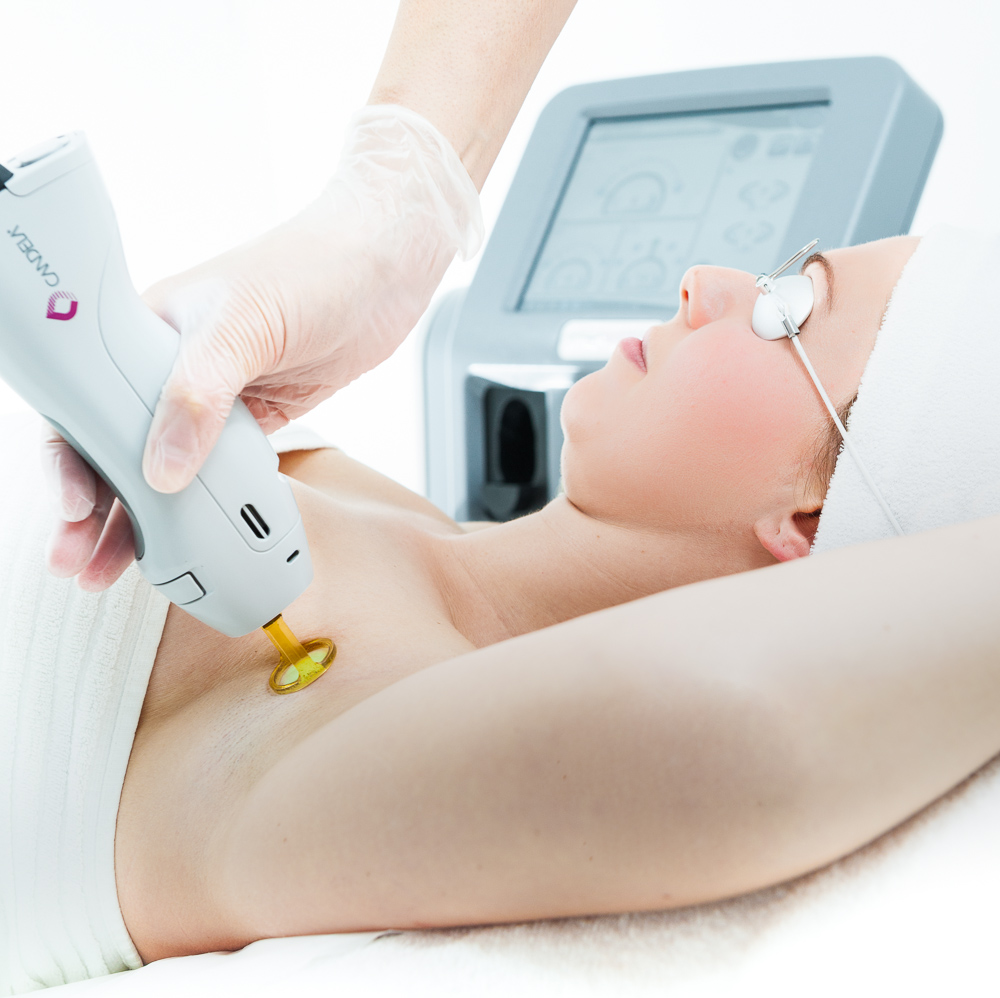 Laser Hair Removal in Toronto | IGBeauty