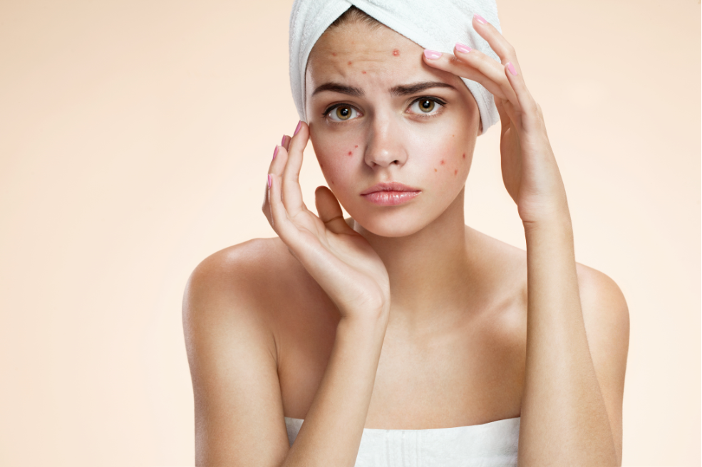 Laser treatments for acne scars from IGBeauty Studio | Toronto