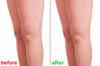Do Treatments for Spider Vein Removal Work?
