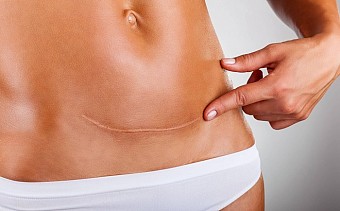 IGBeauty: Is Laser Scar Removal In Toronto Worth It?