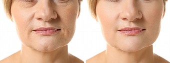  Mesotherapy vs. Microneedling