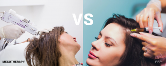 Mesotherapy vs. PRP for Hair Loss Treatment