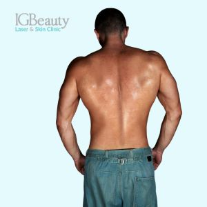 Which Areas Can Be Treated With Laser Hair Removal for Men?