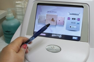Skin Tag Treatment at IGBeauty Skin Care and Laser Hair removal clinic in Toronto