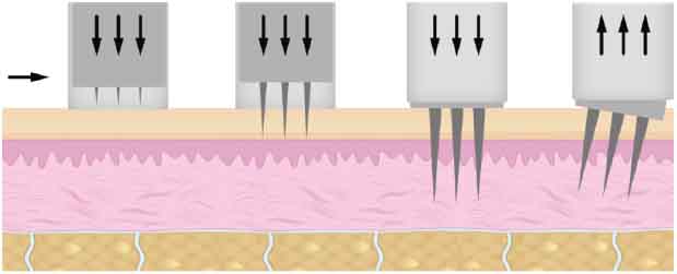 eDermastamp at IGBeauty Skin Care and Laser Clinic in Toronto TO