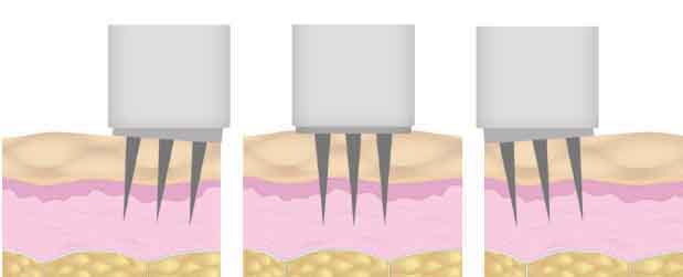 eDermastamp at IGBeauty Skin Care and Laser Clinic in Toronto TO