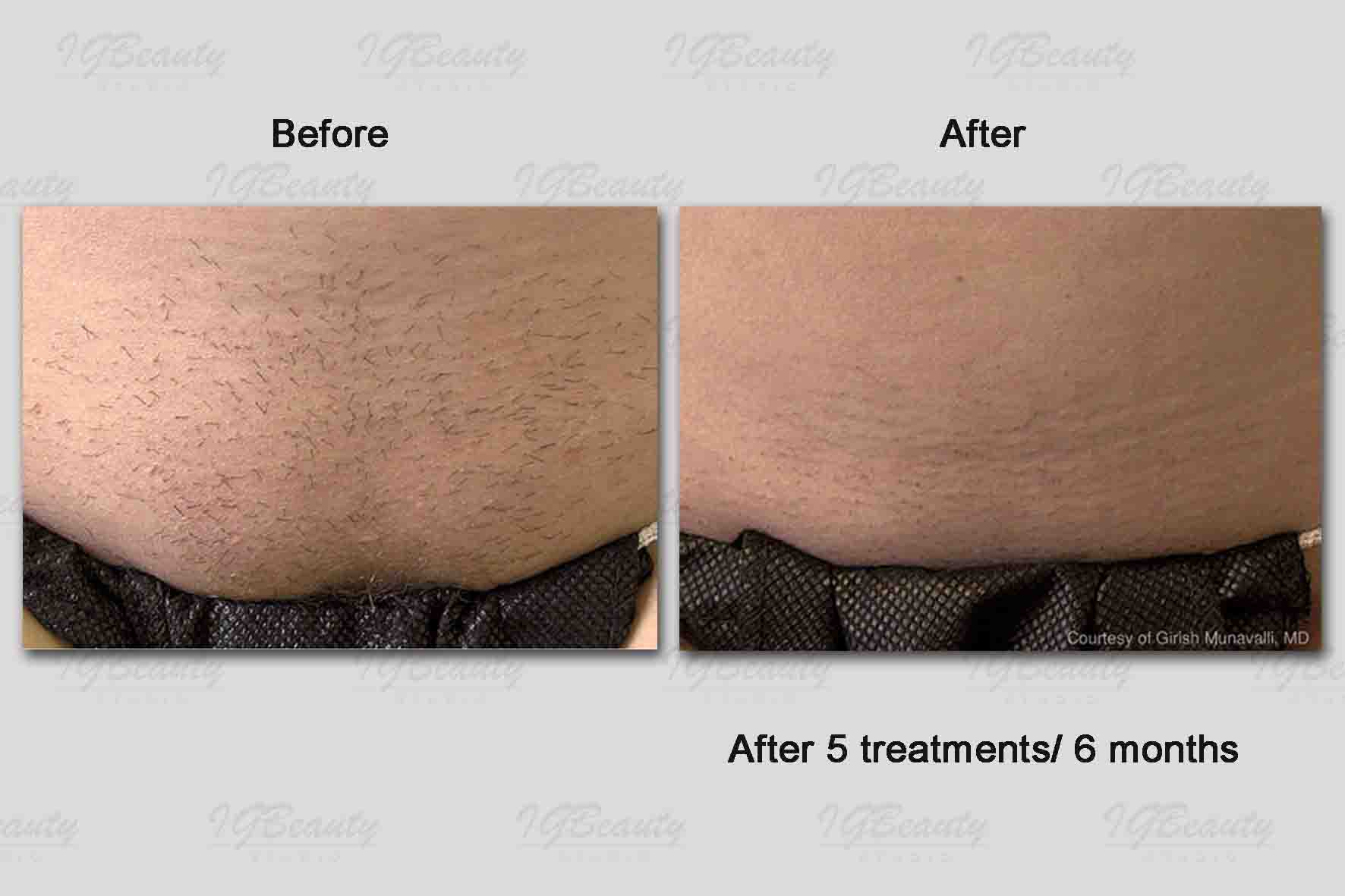 Brazilian Laser Hair Removal Before And After Photos Hair Style Blog