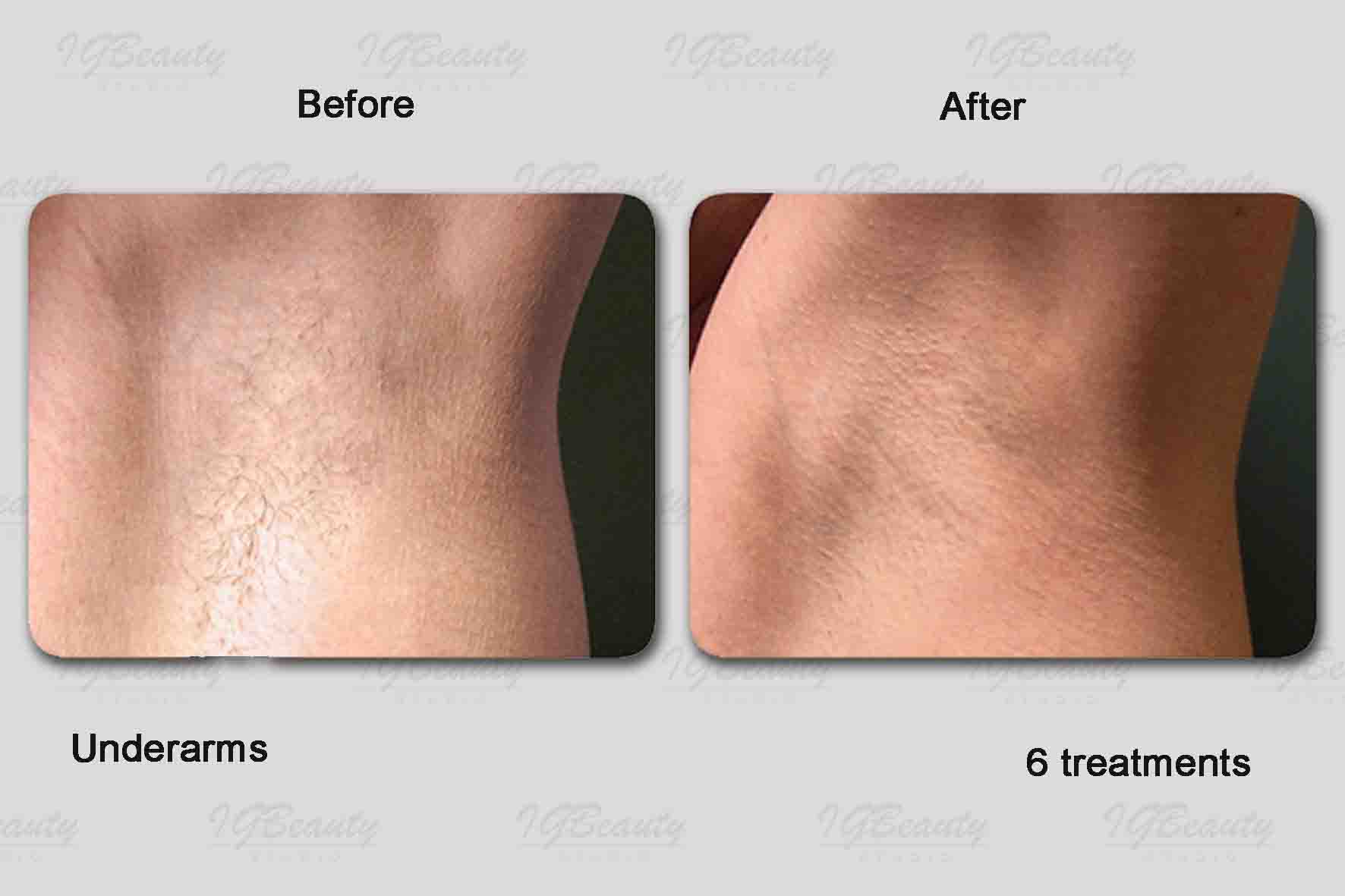 3. Brazilian Beauty: Laser Hair Removal Brisbane - wide 9