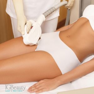 Brazilian laser hair removal