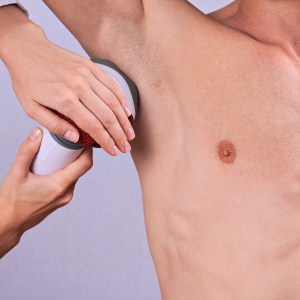 laser hair removal for men