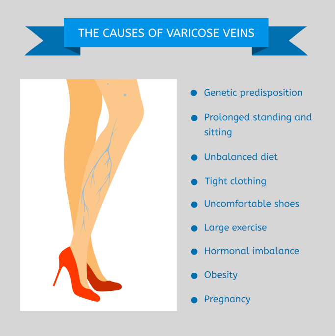 causes varicose veins graphic toronto