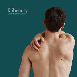 laser hair removal for back