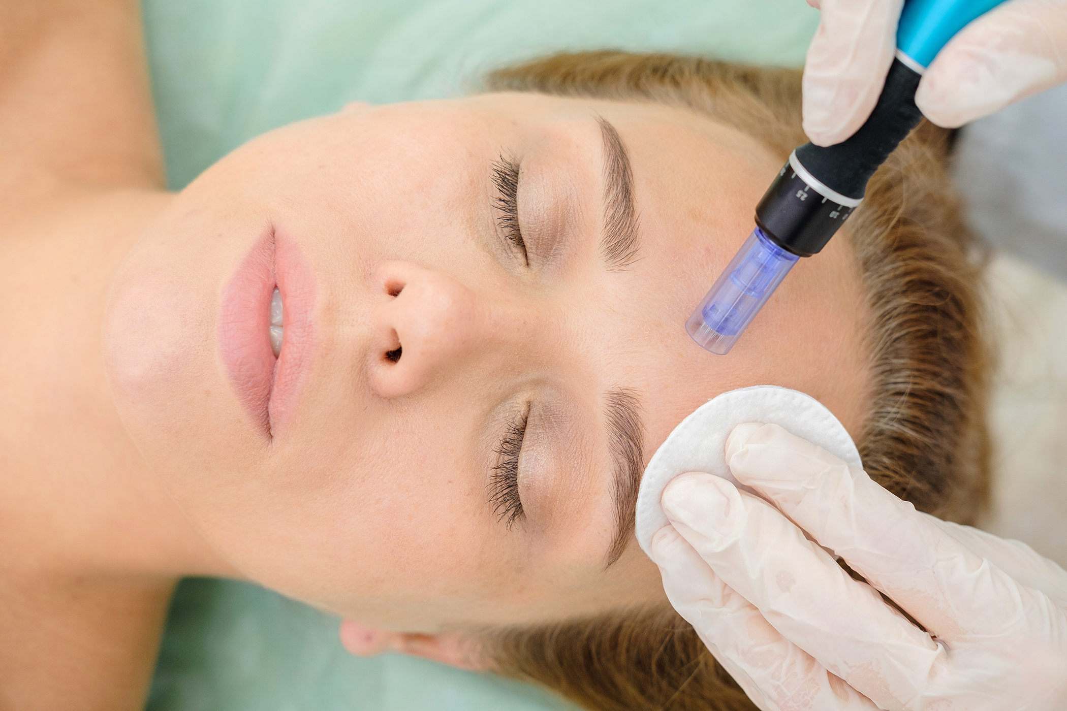 microneedling treatment by igbeauty in toronto 