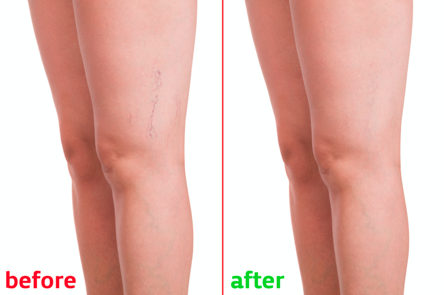 spider vein removal toronto